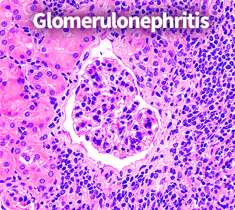 Renal Pathology